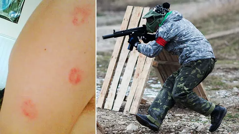 How to Treat & Prevent Paintball Bruises and Welts